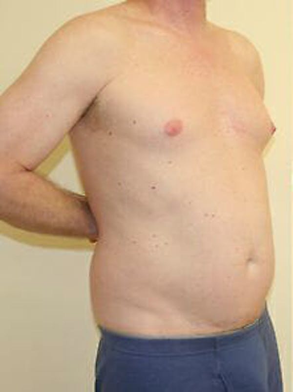 Male Liposuction Before & After Gallery - Patient 9605757 - Image 3