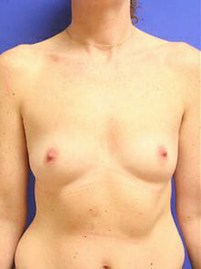 Breast Augmentation Before & After Gallery - Patient 9605756 - Image 1