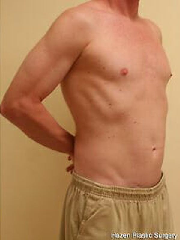 Male Liposuction Gallery - Patient 9605757 - Image 4