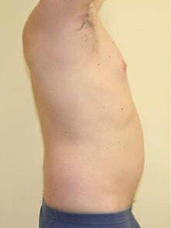 Male Liposuction Before & After Gallery - Patient 9605757 - Image 5
