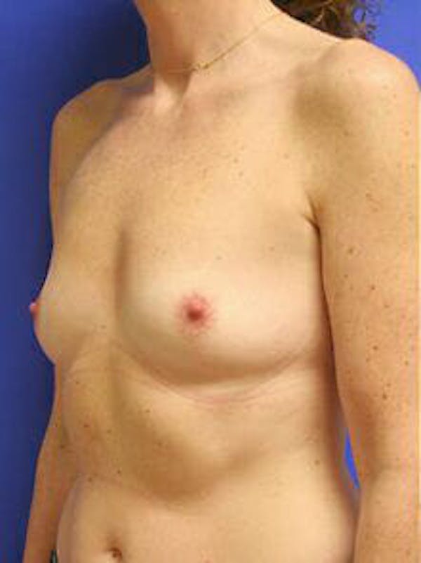 Breast Augmentation Before & After Gallery - Patient 9605756 - Image 3