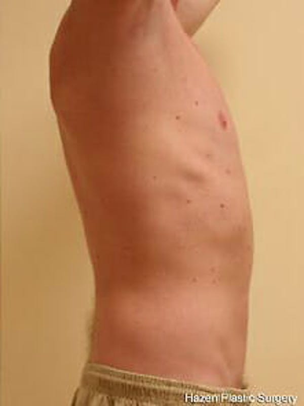 Male Liposuction Before & After Gallery - Patient 9605757 - Image 6