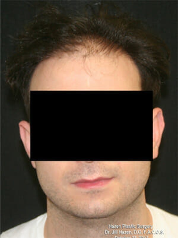 NeoGraft Before & After Gallery - Patient 9605758 - Image 1