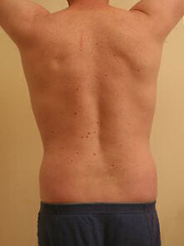 Male Liposuction Before & After Gallery - Patient 9605757 - Image 7
