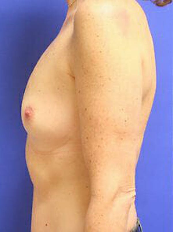 Breast Augmentation Before & After Gallery - Patient 9605756 - Image 5