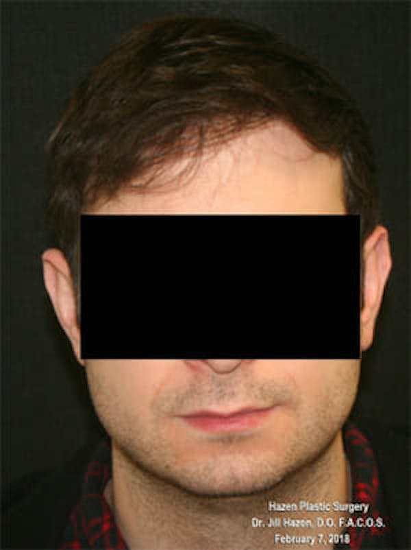 NeoGraft Before & After Gallery - Patient 9605758 - Image 2