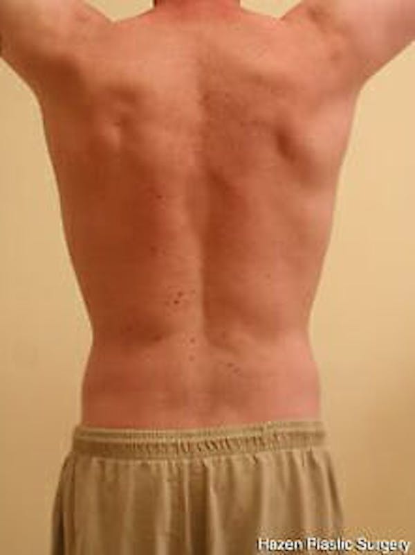 Male Liposuction Before & After Gallery - Patient 9605757 - Image 8