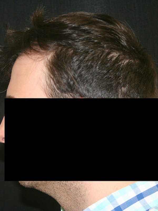 NeoGraft Before & After Gallery - Patient 9605758 - Image 3