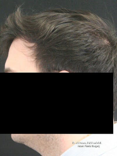 NeoGraft Before & After Gallery - Patient 9605758 - Image 4