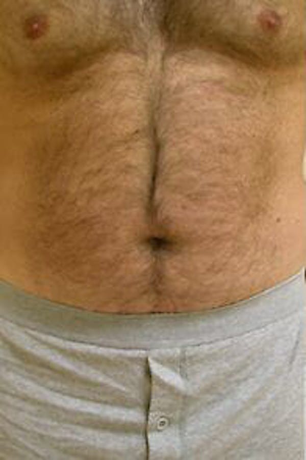Male Liposuction Before & After Gallery - Patient 9605760 - Image 1