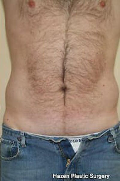 Male Liposuction Before & After Gallery - Patient 9605760 - Image 2