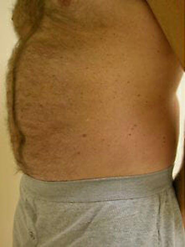 Male Liposuction Before & After Gallery - Patient 9605760 - Image 3