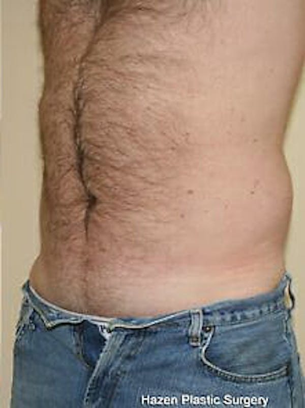 Male Liposuction Before & After Gallery - Patient 9605760 - Image 4