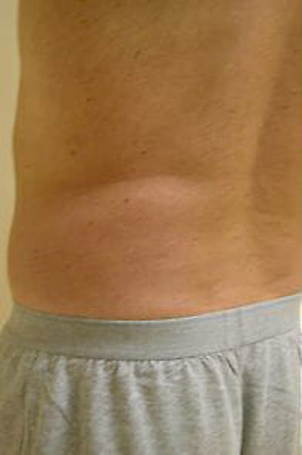Male Liposuction Before & After Gallery - Patient 9605760 - Image 5