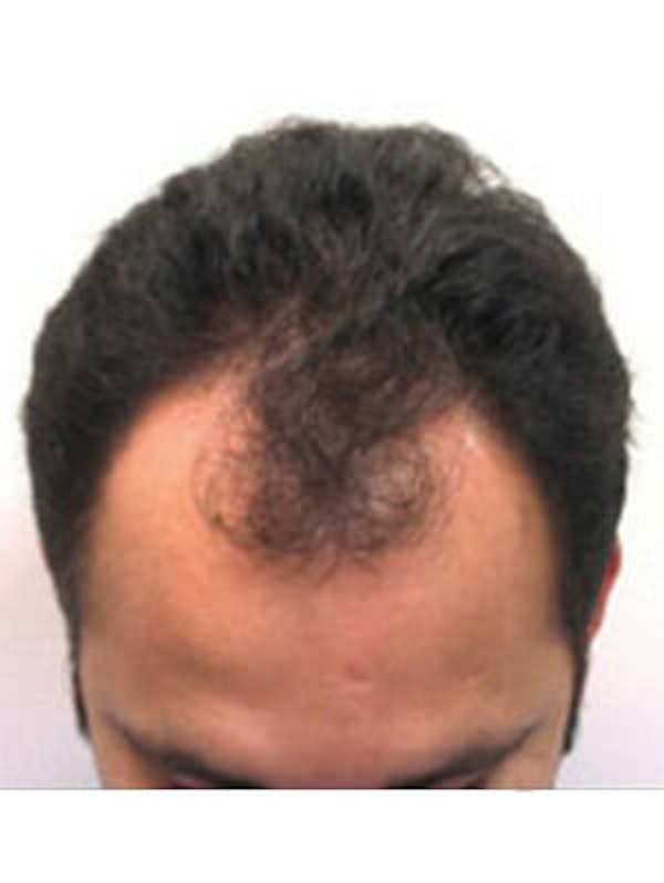 Neograft