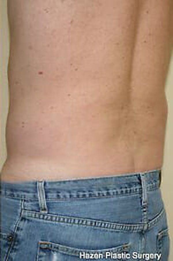 Male Liposuction Before & After Gallery - Patient 9605760 - Image 6