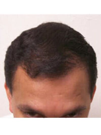 NeoGraft Before & After Gallery - Patient 9605759 - Image 2