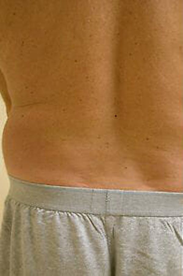 Male Liposuction Before & After Gallery - Patient 9605760 - Image 7