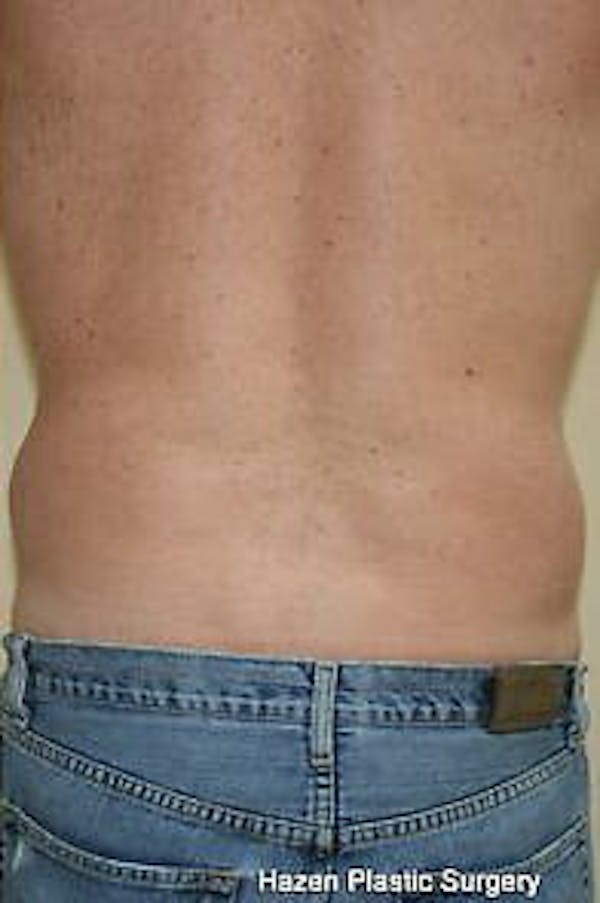Male Liposuction Gallery - Patient 9605760 - Image 8