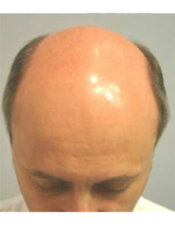 NeoGraft Before & After Gallery - Patient 9605761 - Image 1