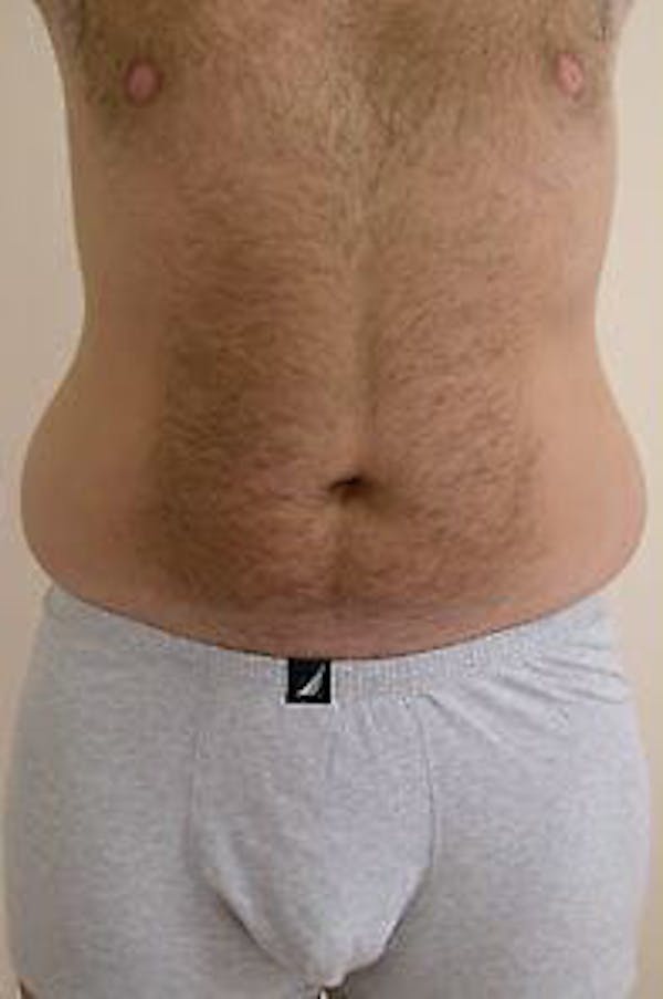Male Liposuction Gallery - Patient 9605762 - Image 1