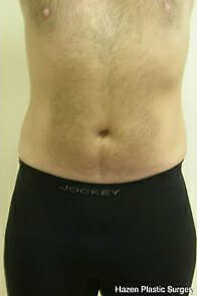 Male Liposuction Before & After Gallery - Patient 9605762 - Image 2