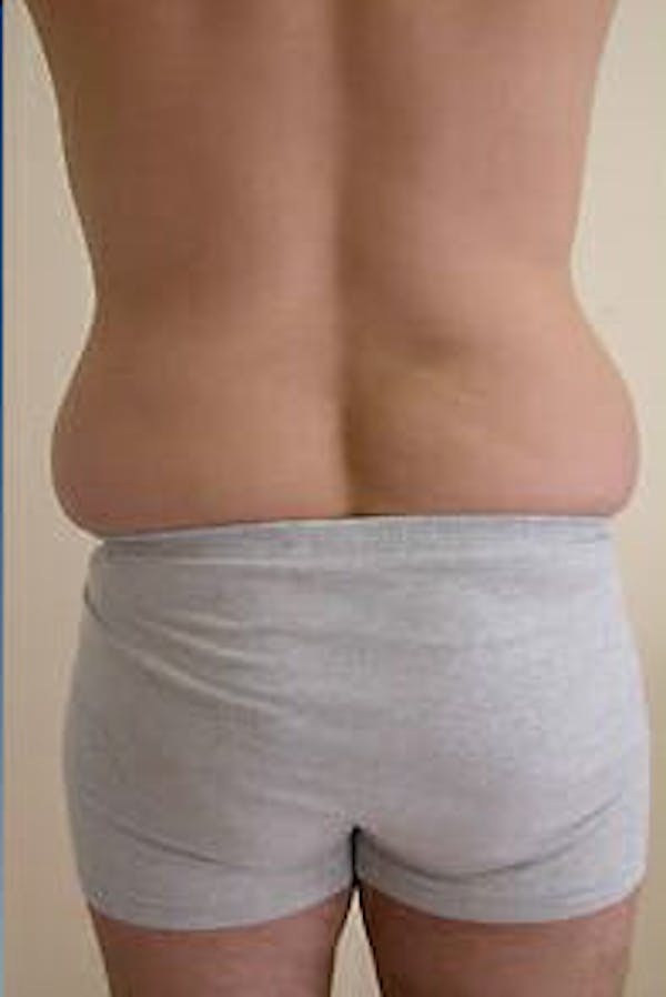 Male Liposuction Before & After Gallery - Patient 9605762 - Image 3