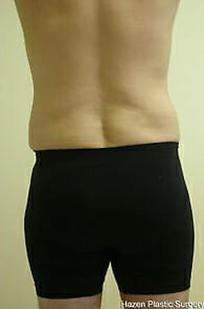 Male Liposuction Before & After Gallery - Patient 9605762 - Image 4