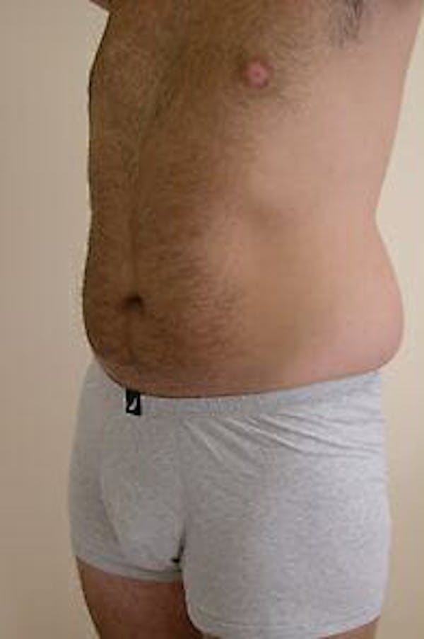Male Liposuction Before & After Gallery - Patient 9605762 - Image 5