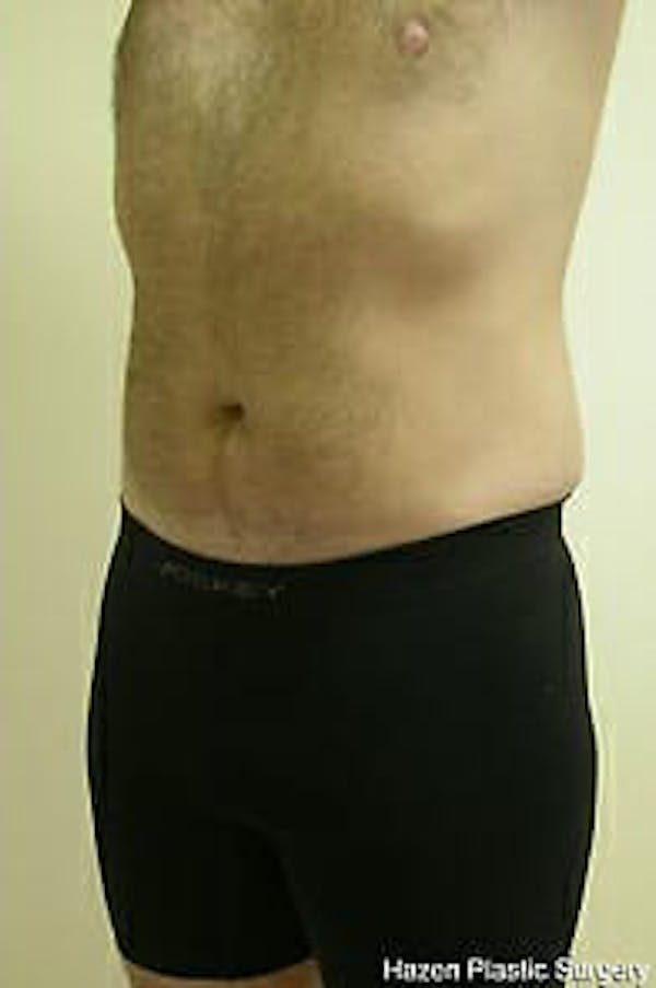 Male Liposuction Before & After Gallery - Patient 9605762 - Image 6