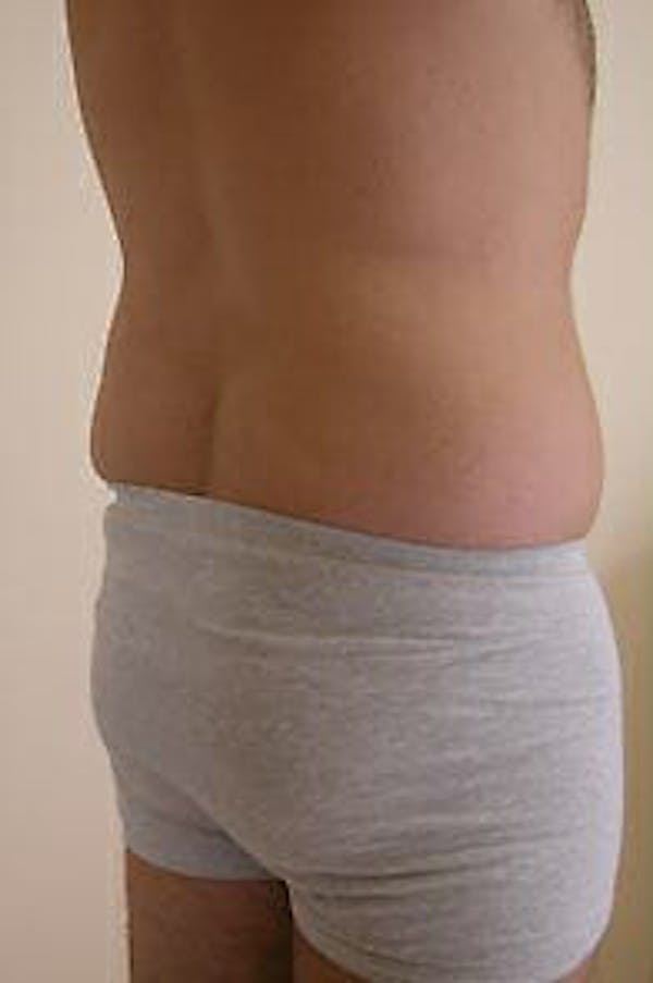 Male Liposuction Before & After Gallery - Patient 9605762 - Image 7