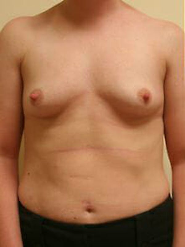 Breast Augmentation Gallery - Patient 9605763 - Image 1