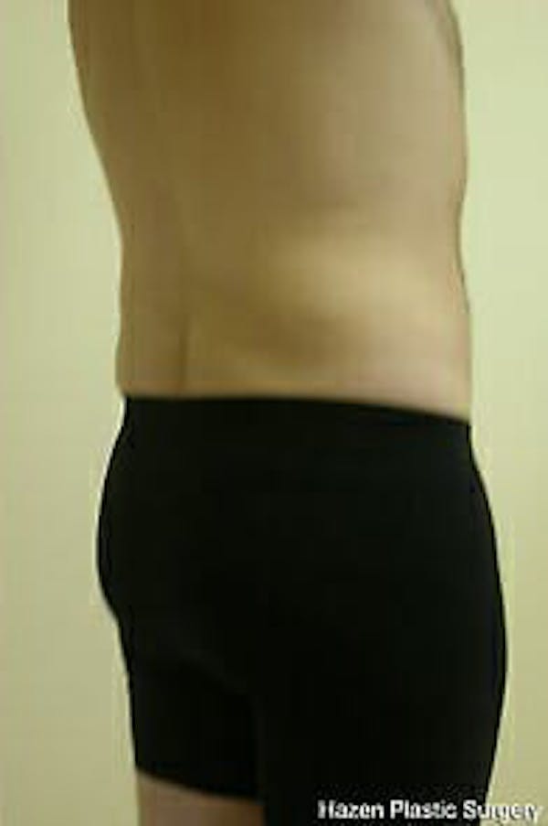 Male Liposuction Before & After Gallery - Patient 9605762 - Image 8
