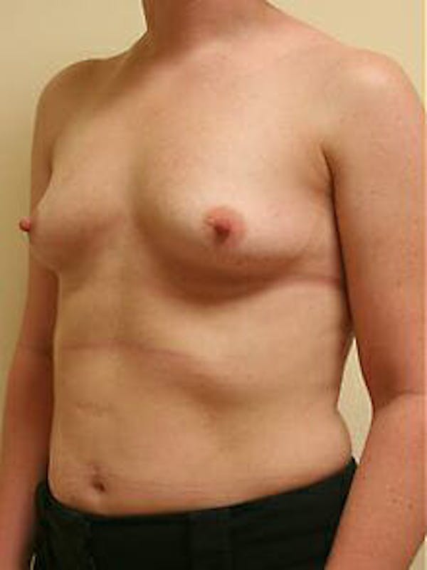 Breast Augmentation Before & After Gallery - Patient 9605763 - Image 3