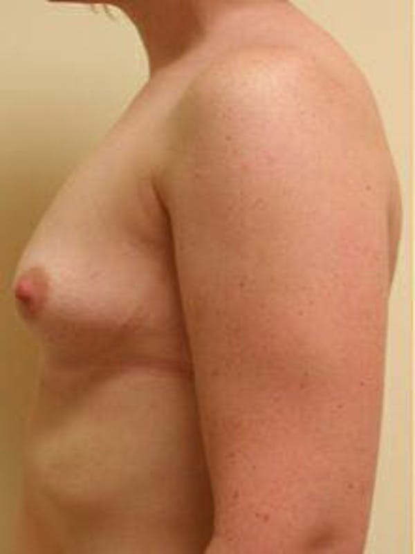 Breast Augmentation Before & After Gallery - Patient 9605763 - Image 5