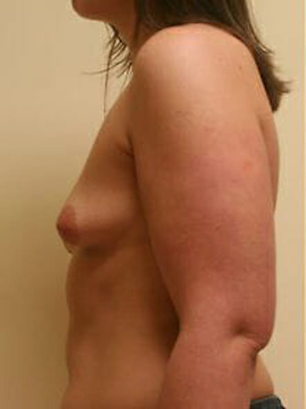 Breast Augmentation Before & After Gallery - Patient 9605767 - Image 5