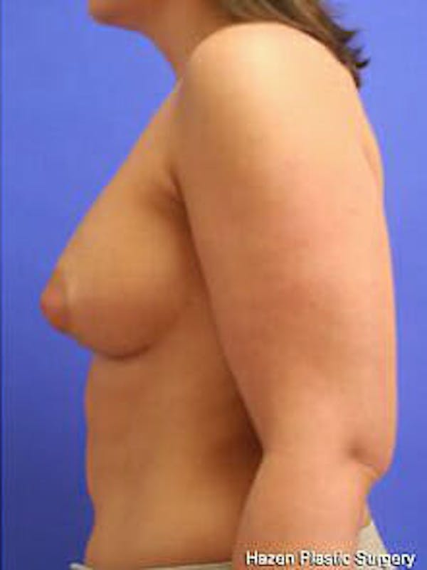 Breast Augmentation Before & After Gallery - Patient 9605767 - Image 6