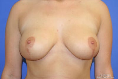 Breast Reduction Before & After Gallery - Patient 9605768 - Image 2