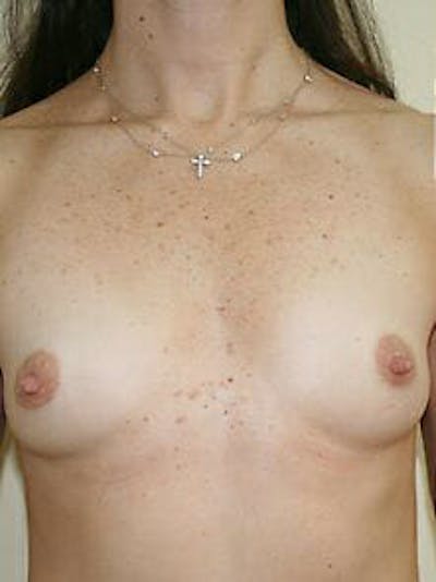 Breast Augmentation Before & After Gallery - Patient 9605770 - Image 1