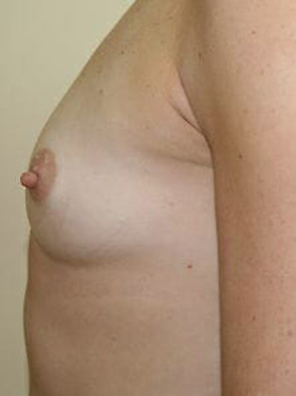 Breast Augmentation Before & After Gallery - Patient 9605770 - Image 5
