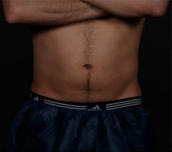 TruSculpt Before & After Gallery - Patient 9605773 - Image 1