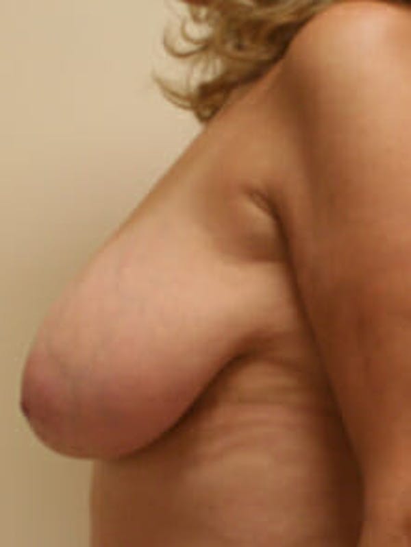 Breast Reduction Before & After Gallery - Patient 9605777 - Image 5