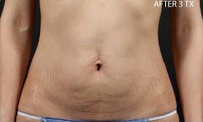 TruSculpt Before & After Gallery - Patient 9605775 - Image 2