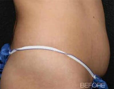 TruSculpt Before & After Gallery - Patient 9605779 - Image 1