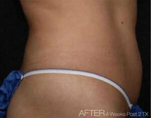 TruSculpt Before & After Gallery - Patient 9605779 - Image 2