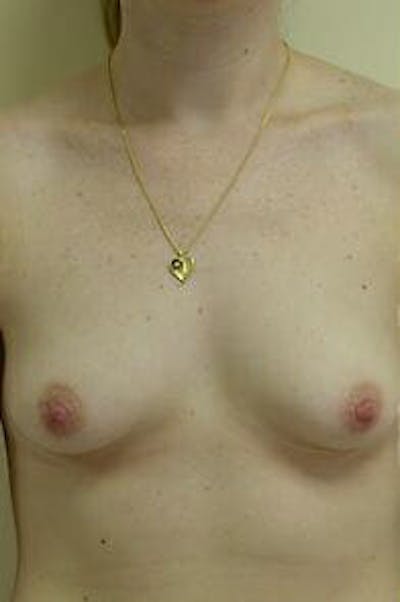 Breast Augmentation Before & After Gallery - Patient 9605783 - Image 1