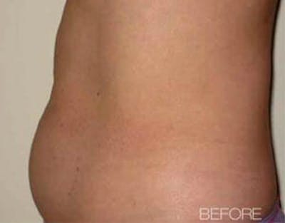 TruSculpt Before & After Gallery - Patient 9605780 - Image 1
