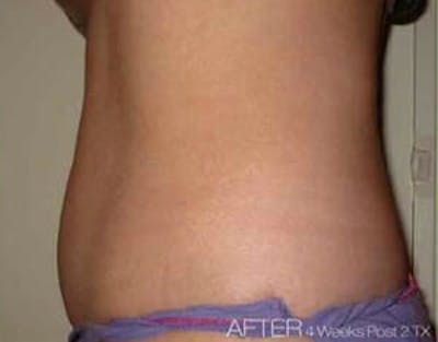 TruSculpt Before & After Gallery - Patient 9605780 - Image 2