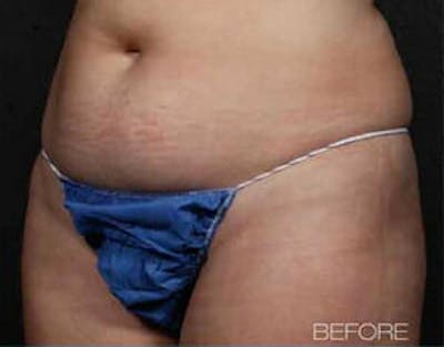 TruSculpt Before & After Gallery - Patient 9605782 - Image 1