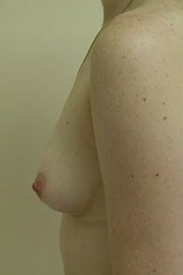Breast Augmentation Before & After Gallery - Patient 9605783 - Image 5